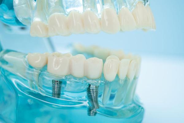 Dental Implants Long Beach, CA
