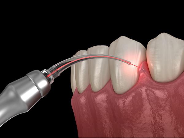 Laser Dentistry Long Beach, CA