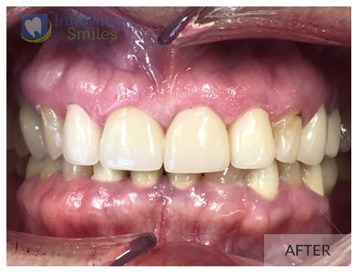 Dr. Jesmine Porcelain Veneers Before and After 1A1