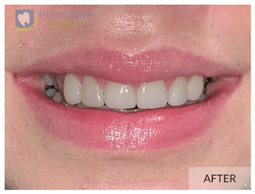 Porcelain Veneers Before and After 1B