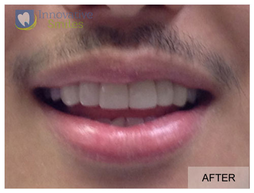 Veneers Before and After 2