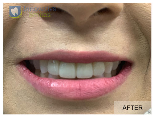 Veneers Before and After 3