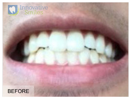 Veneers Before and After 2