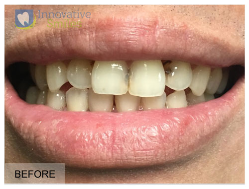 Veneers Before and After 4