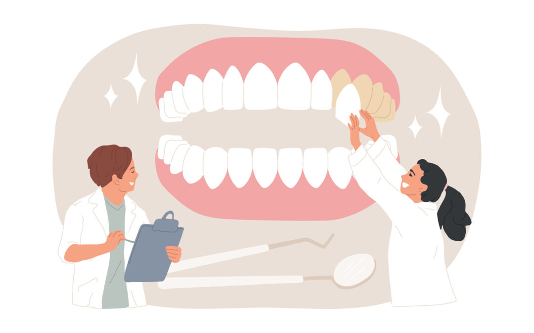 The image shows dentists placing veneers on large teeth model. It represents if veneers last longer than dental bonding.