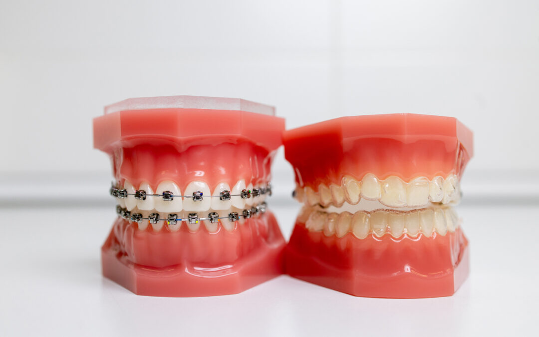 Braces or Invisalign: Which Is Better for You?