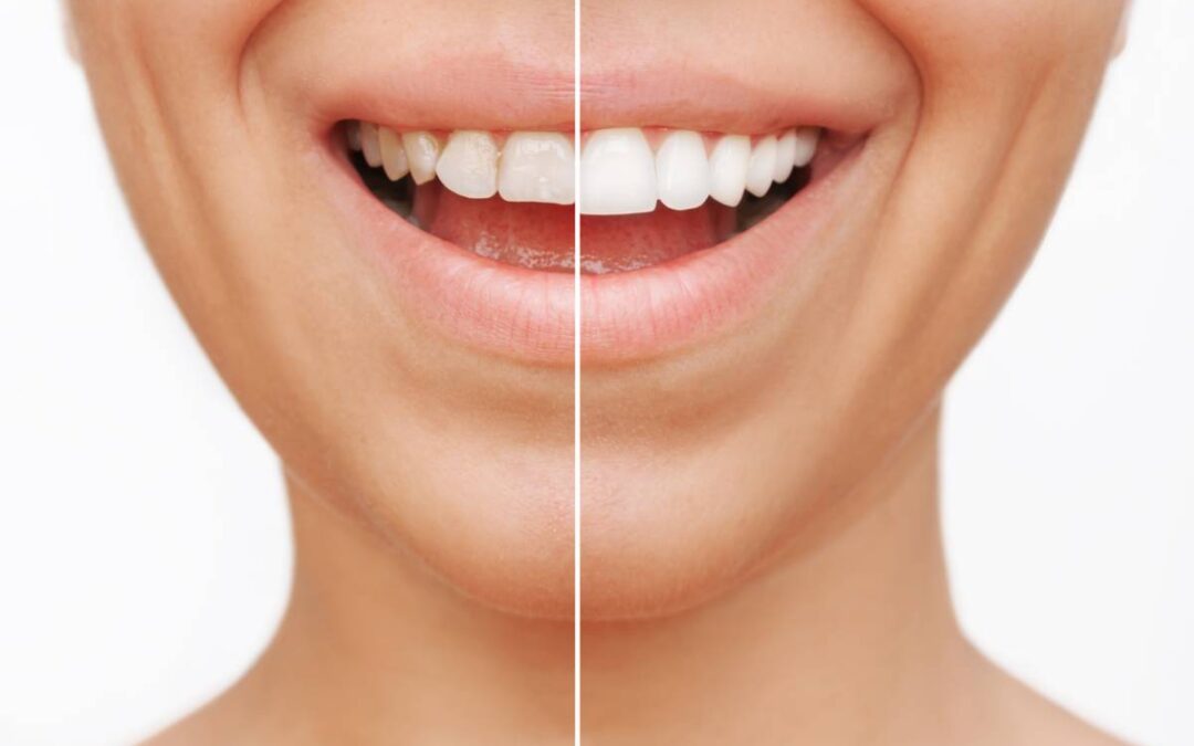 Do Dental Veneers Stain?