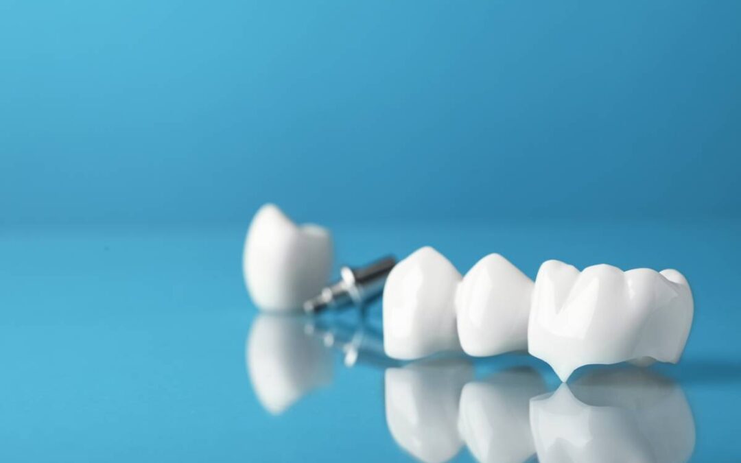 featured image for what type of dental bridge is best for you